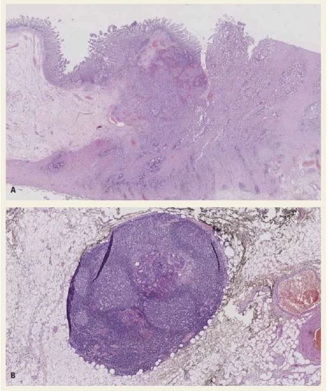 A, B. Histological section – ampullary adenocarcinoma. Tumour glands invade the duodenum wall. Haematoxylin-eosin staining 10× (A). Histological section – regional lymph node with metastasis of the adenocarcinoma. Haematoxylin-eosin staining 40× (B).<br>
Obr. 3. A, B. Histologické vyšetření – ampulární adenokarcinom. Nádorové žlázky invadují stěnu duodena. Barvení hematoxylin-eozinem 10× (A). Histologické vyšetření – regionální lymfatická uzlina s metastázou adenokarcinomu. Barvení hematoxylin-eozinem 40× (B).