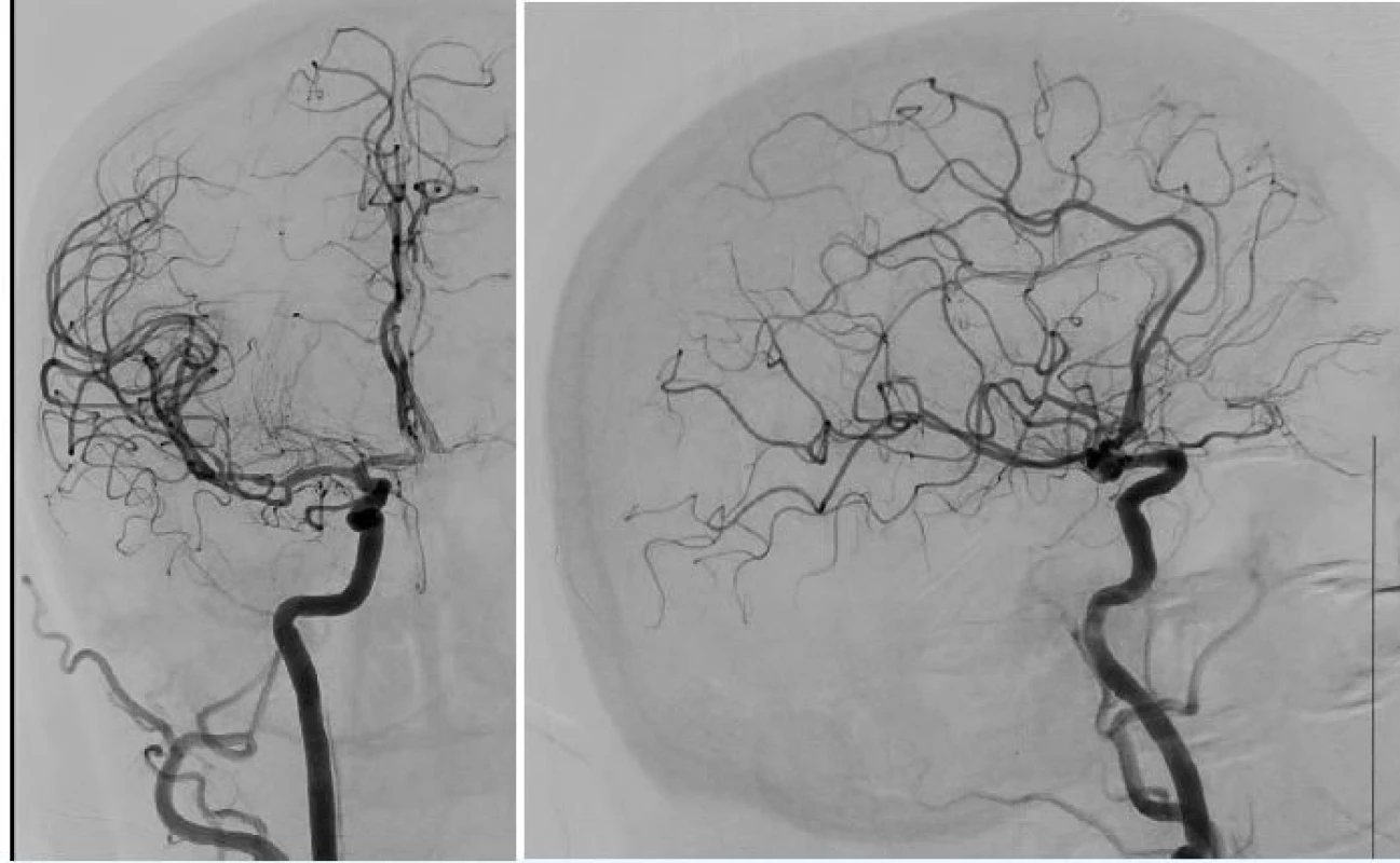 a 5 Kontrolní angiografie s plným obnovením toku (TICI 3) v zadopřední a boční projekci