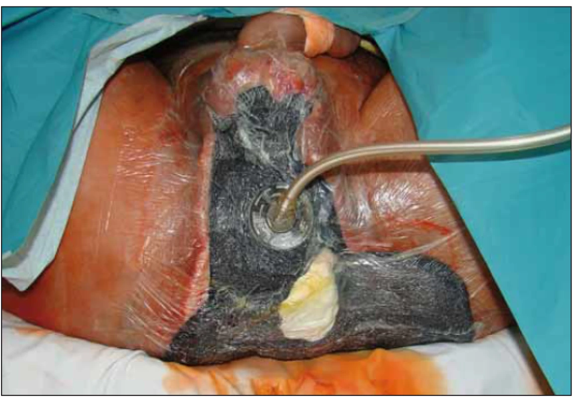 Aktivní odsávání.<br>
Fig. 6. Active suction.