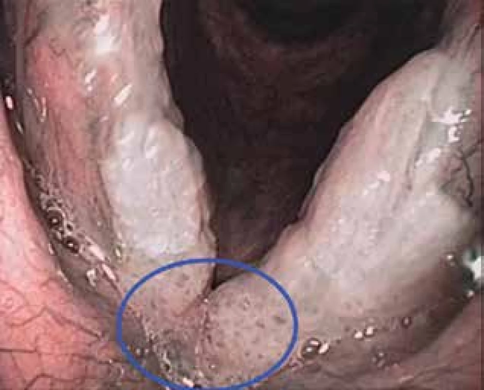Patologická vaskularizace v NBI (IPCL Va typu dle Ni) v oblasti přední komisury při leukoplakii hlasivek (značeno modrým kruhem)