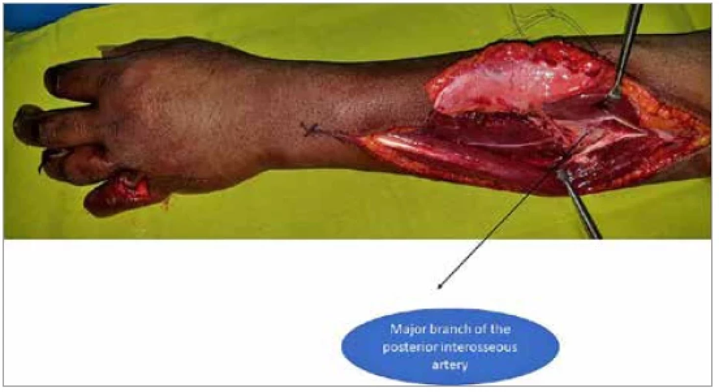 Posterior interosseous flap has been harvested on a major branch
of the posterior interosseous vessels. The arrow shows the main posterior
interosseous vessel before giving the branch.