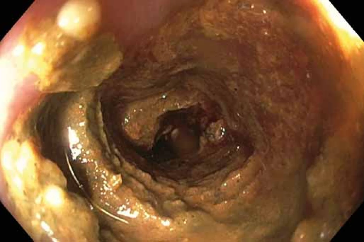 Stupeň střevní přípravy D. Zdroj: Archiv oddělení
gastrointestinální endoskopie, ÚVN VFN, Praha.<br>
Fig. 4. Degree of intestinal preparation D. Source: Archive
department of gastrointestinal endoscopy, ÚVN Military
university hospital, Prague.