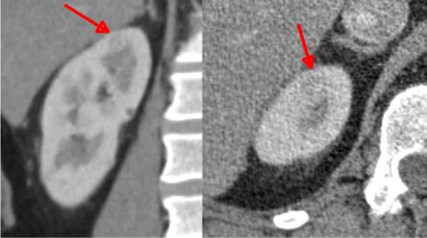 Ložisko velikosti 9 mm na horním pólu,
které bylo odstraněno jako poslední, také bez ischemie<br>
Fig. 10. Nine millimeter lesion on the upper pole,
removed as the last one, also no ischemia