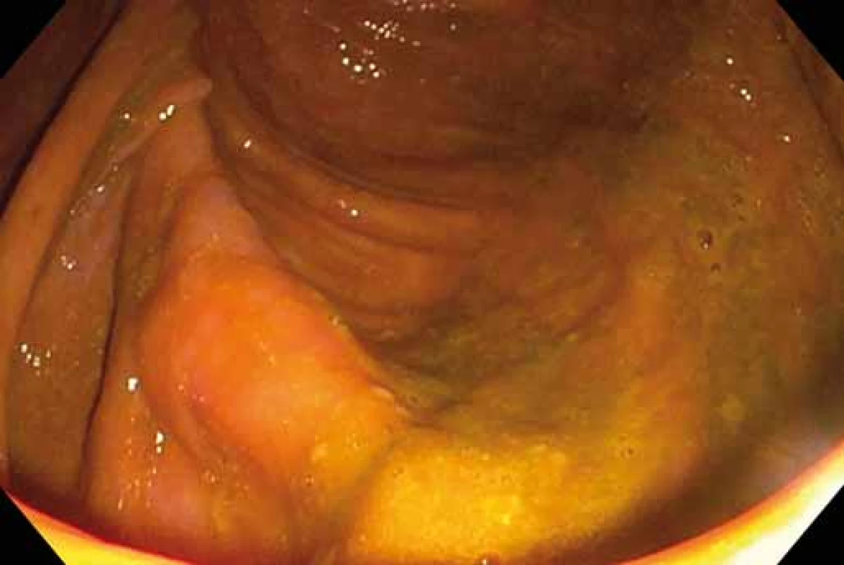 Stupeň střevní přípravy B. Zdroj: Archiv oddělení
gastrointestinální endoskopie, ÚVN VFN, Praha.<br>
Fig. 2. Degree of intestinal preparation B. Source: Archive
department of gastrointestinal endoscopy, ÚVN Military
university hospital, Prague.