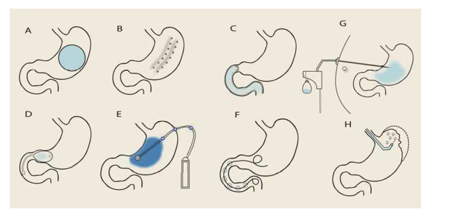 Přehled endoskopických bariatrických výkonů.<br>
A) intragastrický balón, B) endoskopická sleeve gastroplastika, C) duodenojejunální bypass, D) TransPyloris Shuttle, E) elektrická
stimulace, F) SatiSphere, G) aspirační terapie, H) Primary Obesity Surgery Endoluminal (POSE). Autor: J. Král, IKEM, Praha.<br>
Obr. 1. Overview of endoscopic bariatric procedures.<br>
A) intragastric balloon, B) endoscopic sleeve gastroplasty, C) duodenojejunal bypass, D) TransPyloris Shuttle, E) electrical stimulation,
F) SatiSphere, G) aspiration therapy, H) Primary Obesity Surgery Endoluminal (POSE). Source: J. Král, IKEM, Prague.