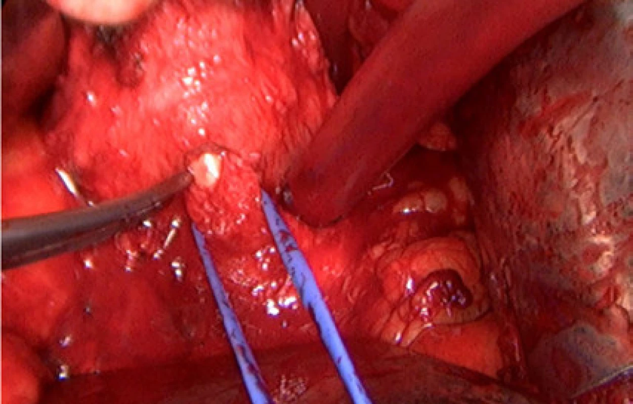 Dokončení přerušení prostatické uretry z dorzální strany<br>
Fig. 6. Completed transection of the prostatic urethra
from the dorsal aspect