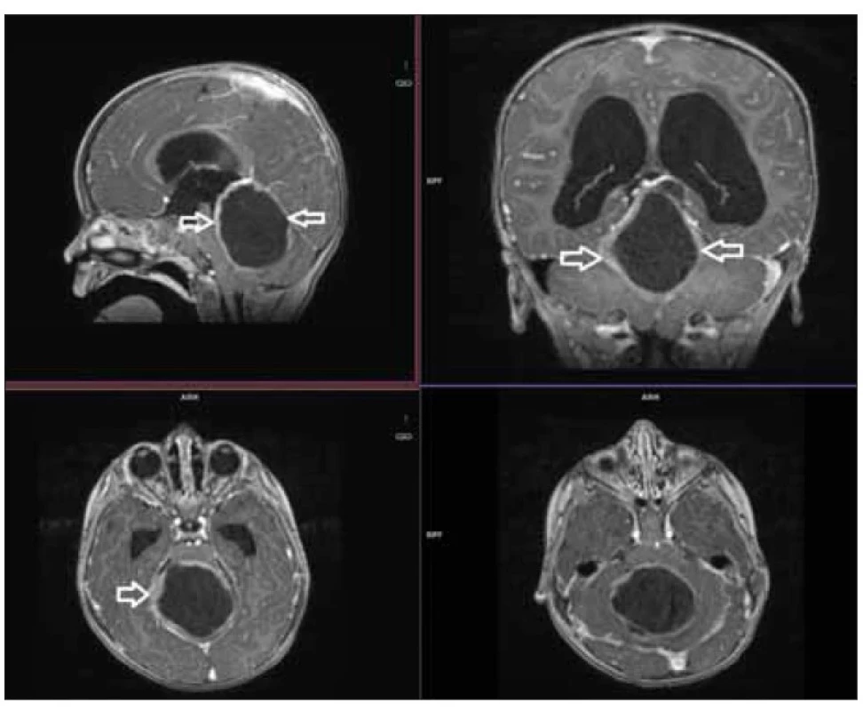 T1 vážený 3D gradientní sken jako
navigační sekvence v případě pilocytárního
astrocytomu zadní jámy.<br>
Fig. 2. T1-weighted 3D gradient scan as
a navigation scan in a case of pilocytic
astrocytoma of the posterior fossa.