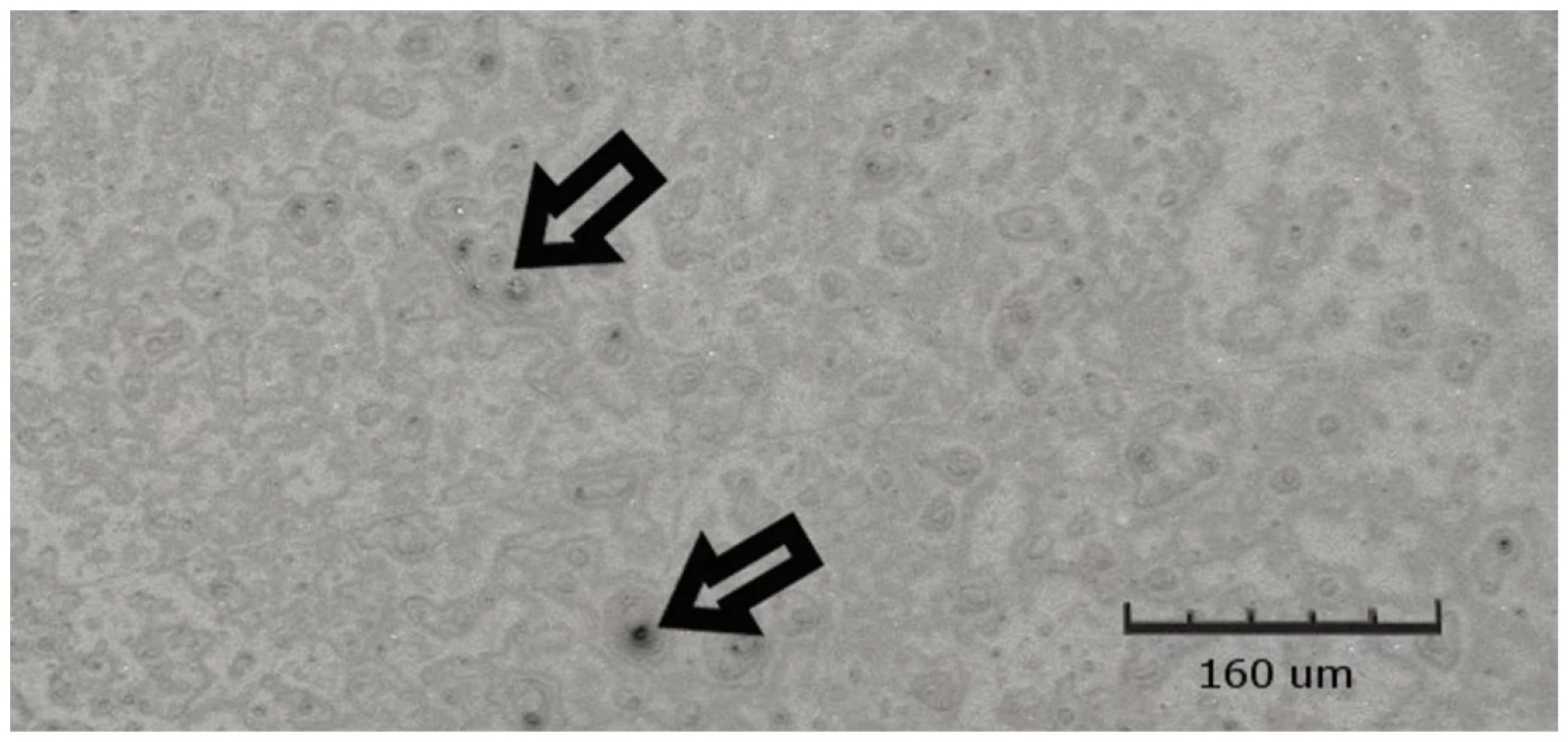 Filtek Ultimate Flow vystavený kyselému pH po dobu 14 dnů, zobrazeno CLSM<br>
Fig. 16 Filtek Ultimate Flow exposed to acidic pH for 14 days, shown by CLSM