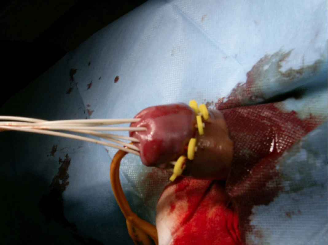 Paralelní aplikace plastických trubiček u pacienta s bifokálním
karcinomem penisu<br>
Fig. 3. Parallel application of plastic
tubes in patient with bifocal penile
carcinoma