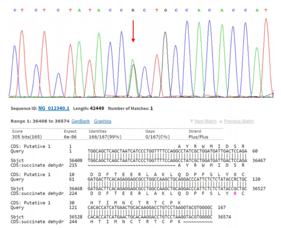SDHB deficientní renální karcinom s nalezenou mutací: NM_003000.2(SDHB): c.725G>A (p.Arg242His).
Sanger sequencing<br>
Fig. 2. SDHB deficient renal cell carcinoma with mutation: NM_003000.2(SDHB): c.725G>A (p.Arg242His).
Sanger sequencing