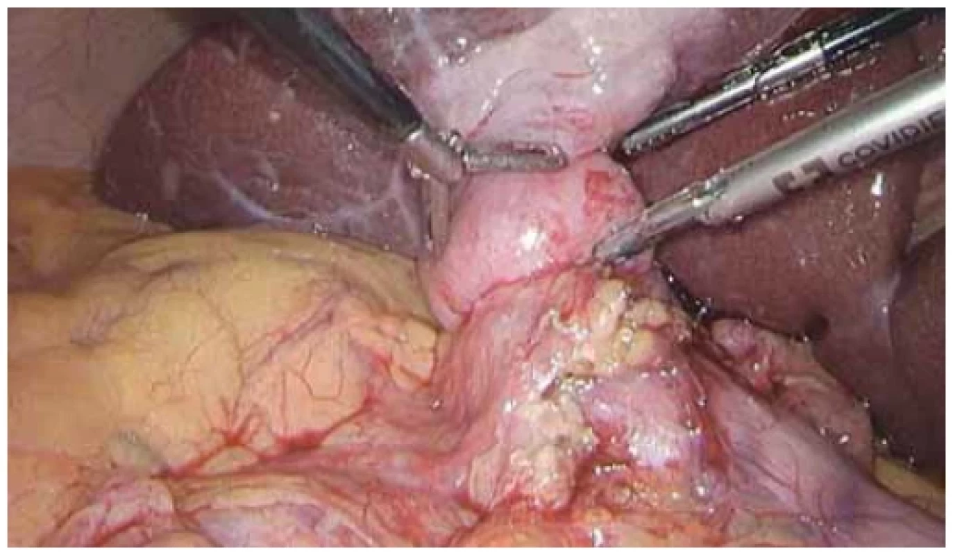 Laparoskopický nález LAMS ve žlučníku a duodenu. <br> 
Fig. 11. Laparoscopic fi nding of LAMS in the gallbladder and duodenum.