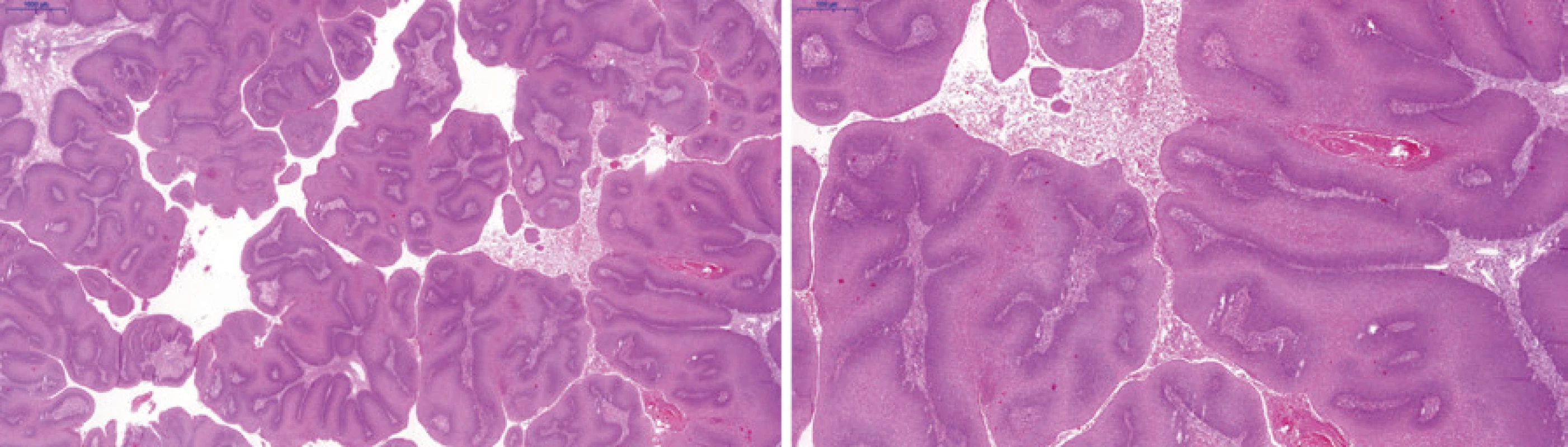Objemná papilárně uspořádaná exofytická léze s low-grade morfologií a prominujícími fibrovaskulárními
papilami, tzv. „pushing“ bazí<br>
Fig. 3. Exophytic papillary lesion of low grade morphology with prominent fibrovascular papillae, so called „pushing
borders“