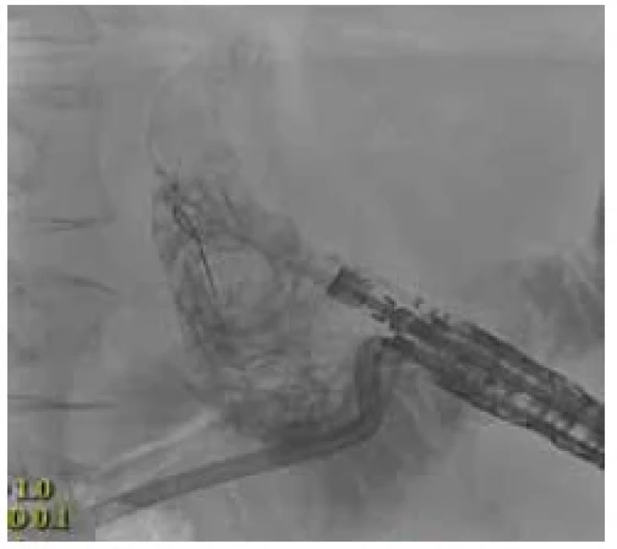 Skiaskopické zobrazení výměny
zevní drenáže žlučníku za vnitřní. <br> 
Fig. 5. X-ray image of replacing the external
drainage of the gallbladder with an internal
one.