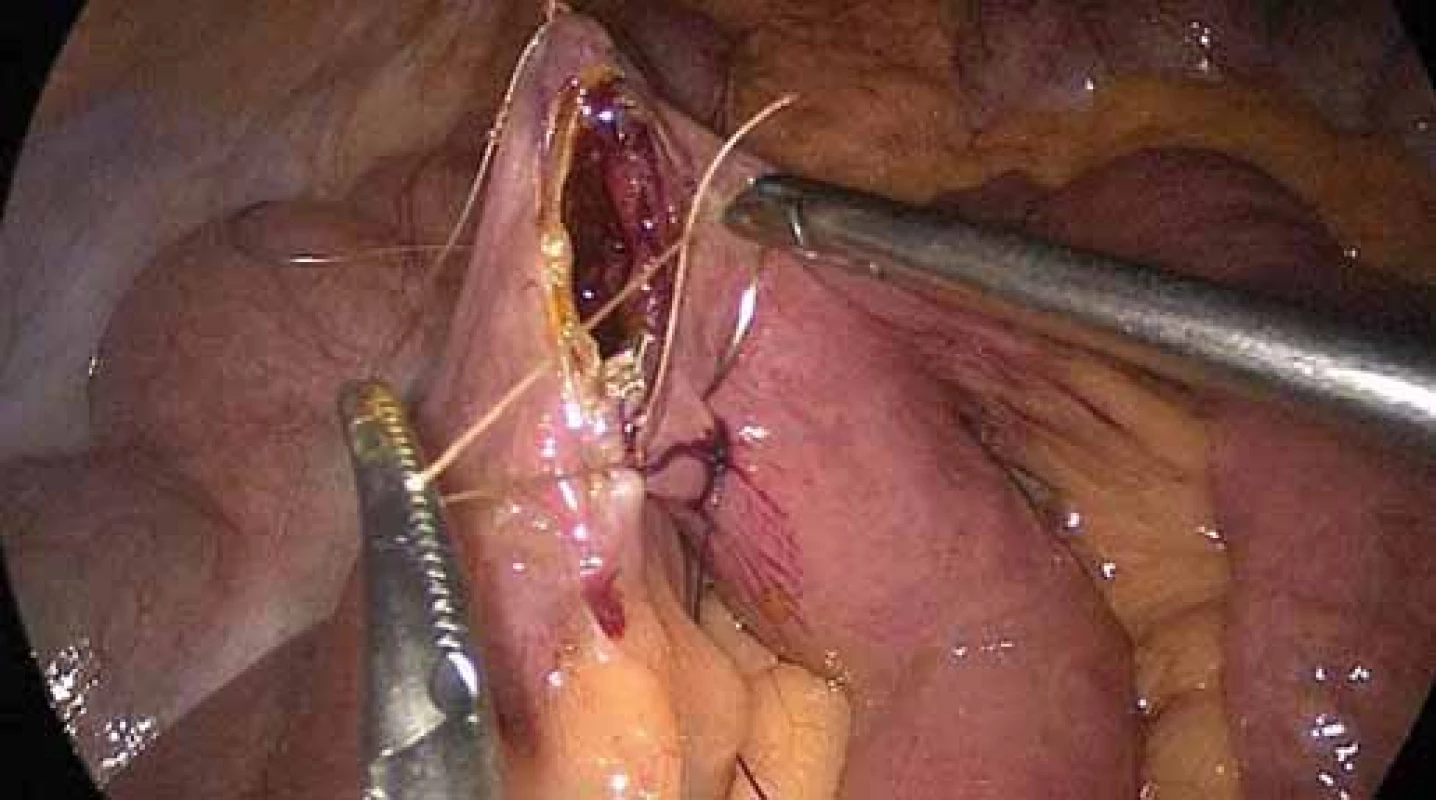 Šití jejun-oileální anastomózy.
Fig. 2. Jejuno-ileal anastomosis suture.
