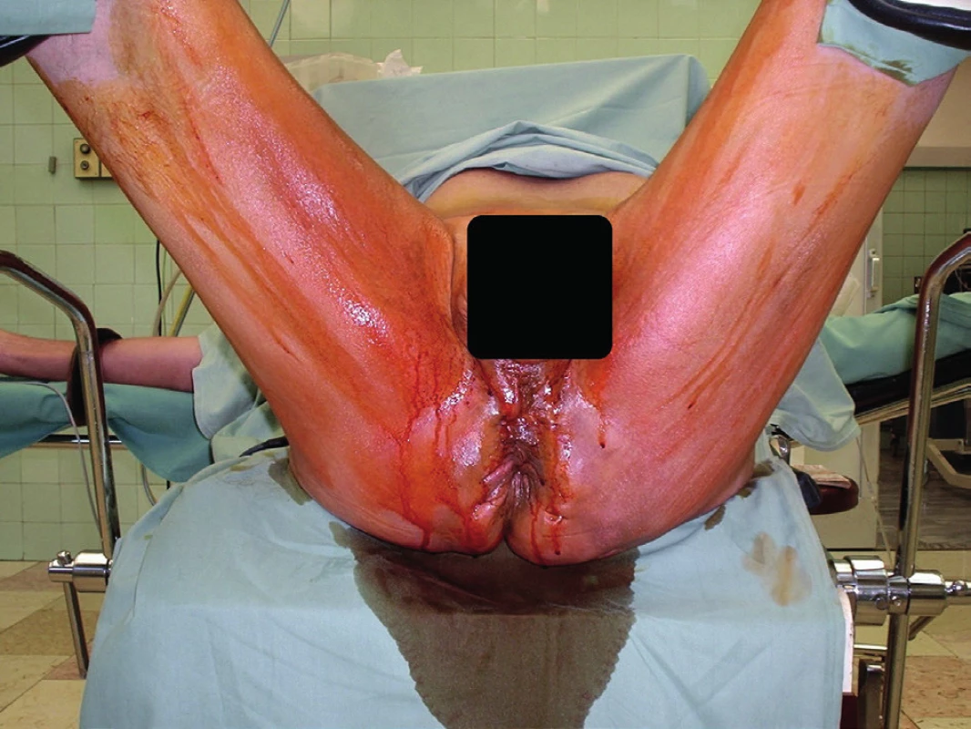Předoperační nález<br>
Fig. 1: Preoperative finding