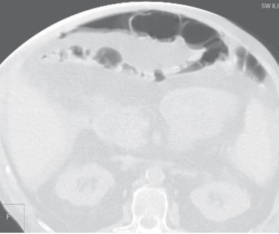 CT vyšetření břicha, pneumoperitoneum, volný plyn pod břišní stěnou.<br>
Fig. 4. CT image of the abdomen, with a pneumoperitoneum, and free gas under
the abdominal wall.