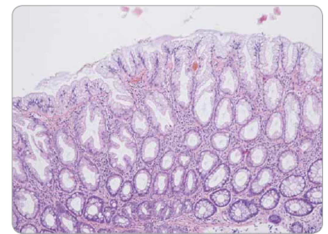 Hyperplastický polyp tračníku – pilovité uspořádání epitelu
ve svrchní polovině krypt, bazální polovina krypt bez dilatace
a bez pilovité kontury.