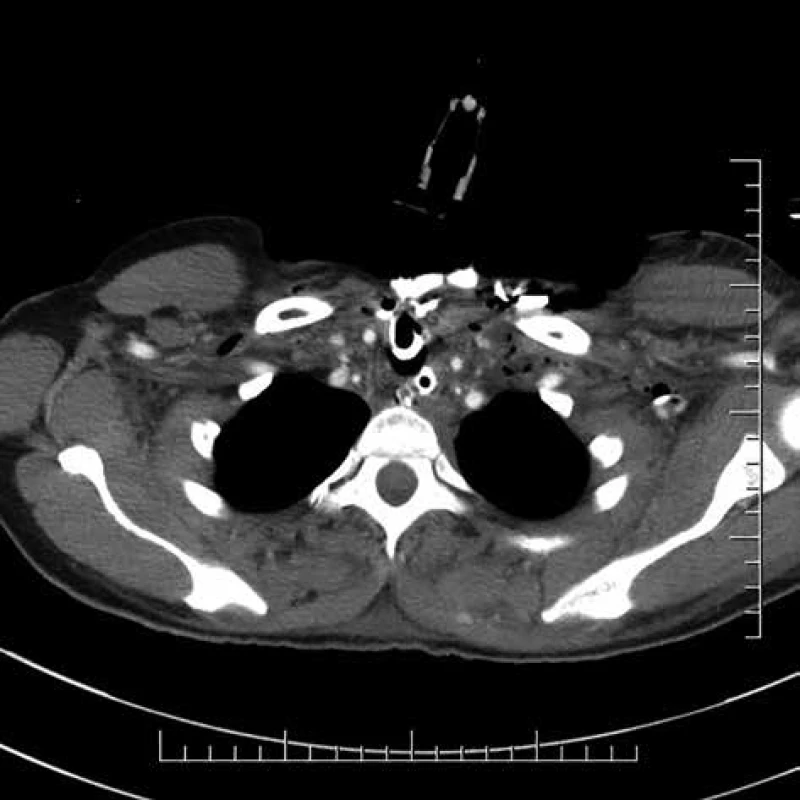 Hlboká krčná infekcia <br>Fig. 1: Deep neck infection