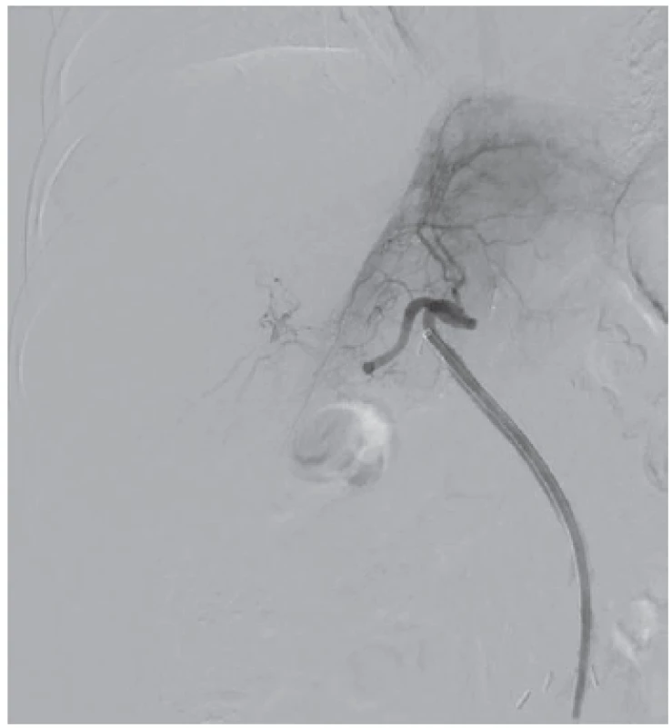 DSA pred začatím trombolýzy – dochádza k slabému
plneniu najmä pravého laloka štepu<br>
Fig. 1: DSA before thrombolysis – there is weak perfusion
of the graft, mostly its right lobe