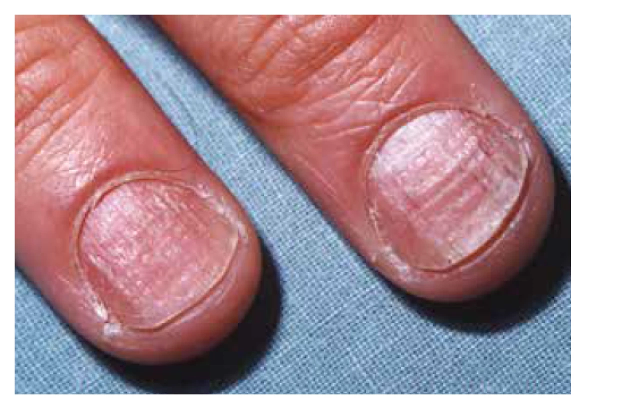 Lichen planus unguium