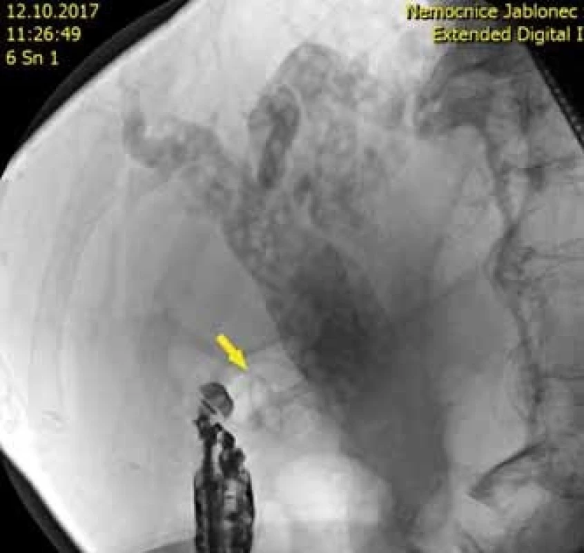 Skiaskopický obraz stentu ve žlučovodu s choledocholithiázou.<br>
Fig. 3. Fluoroscopic imaging of the stent in the bile duct with
choledocholithiasis.