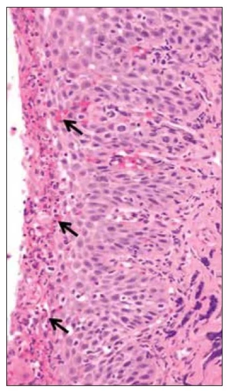 Histologický snímek eozinofilní ezofagitidy
– nediferencované T-buňky, ve sliznici jícnu.