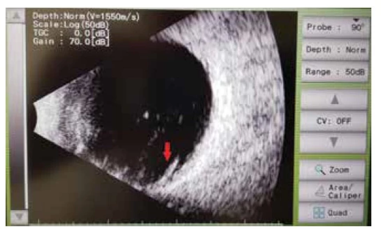 Zobrazení B-scan postiženého oka pacienta 13. Ve
sklivcovém prostoru pohyblivá hyperecha odpovídající sklivcovým
zákalům. Červenou šipkou vyznačen lalok podkovovité
trhliny