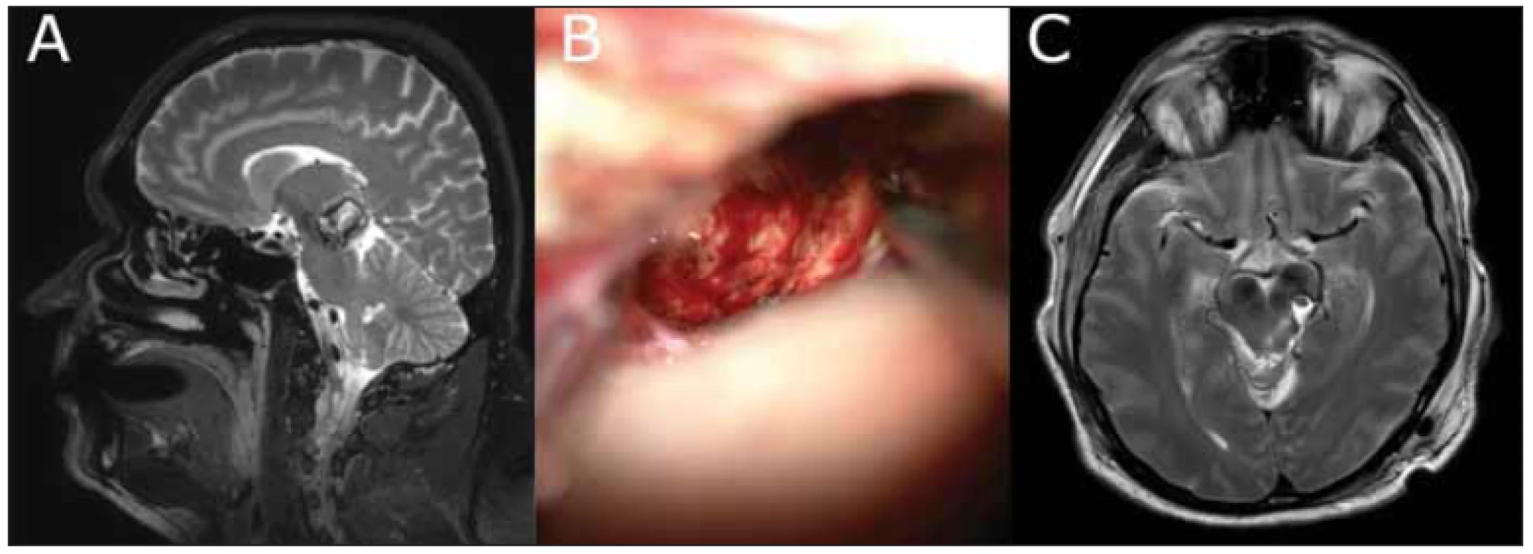Snímky zobrazující průběh léčby 48letého pacienta s prokrváceným kavernomem lemniskálního trianglu mezencefala a talamu
vlevo.  <br>
Fig. 4 Images showing the course of treatment of a 48-year-old male with a cavernoma of the lemniscal trigone of the mesencephalon
and thalamus on the left after bleeding.