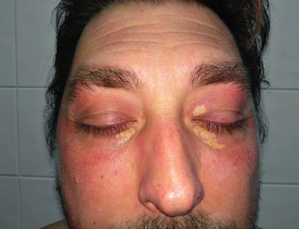Xanthelasmas palpebrarum, Source: photo archive of
authors´ workplace
