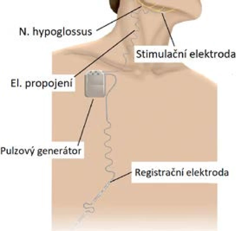 Schéma zapojení selektivní neurostimulace