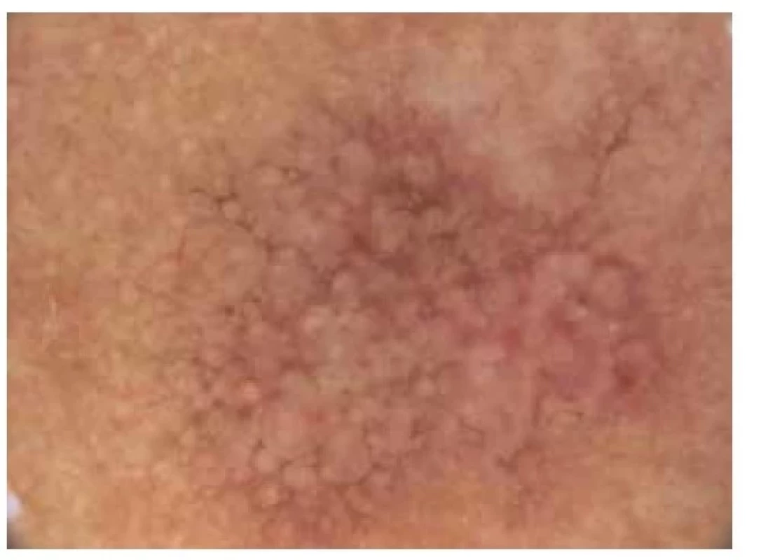 Aktinická keratóza*<br>
Dermatoskopicky červenohnědá barva (erytém +) a výrazně
rozšířené bílé vlasové folikuly.
