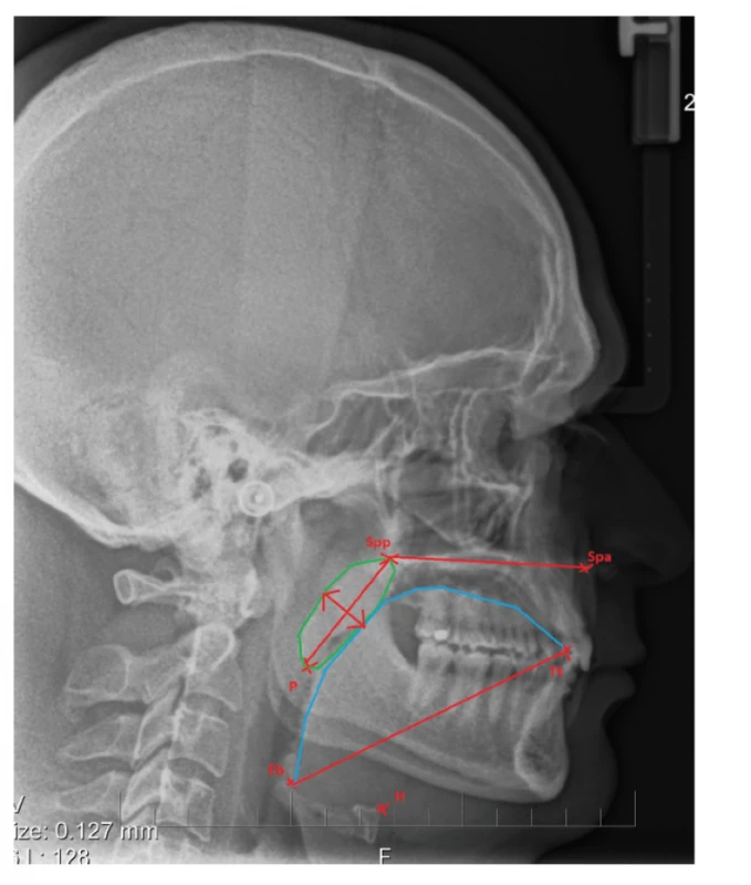 The length of soft palace – the distance between Spp (spina palatina posterior) and the point P (the tip of soft palate); the width of soft palate in the widest place;<br> the length of tongue – distance between the point Tt (the anterior tip of tongue) and the point Eb (base of epiglottis);<br> H – position of hyoid bone
