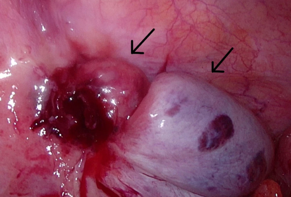 Operační nález: vlevo retinované varle, vpravo
apendix<br>
Fig. 1: On-site situation: Ascended testicle (left); appendix (right)
