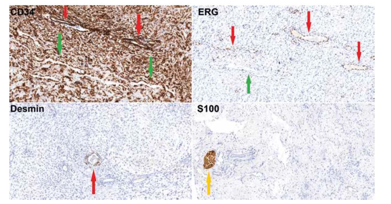 Imunohistochemické vyšetření (20x) dokumentující silnou cytoplazmatickou pozitivitu CD34 ve vřetenitých buňkách, obrovských buňkách, ve
výstelce pseudovaskulárních prostor (zelená šipka) i v pravém endotelu (červená šipka). ERG je pozitivní jen ve výstelce pravých kapilár (červená šipka),
zatímco buňky pseudovaskulárních prostor jsou negativní (zelená šipka). Desmin je pozitivní v hladkosvalových buňkách kolem pravých cév (červená
šipka), samotný nádor je negativní. S100 protein reaguje s periferními nervy v peritumorózních měkkých tkáních (žlutá šipka), nádor je negativní.