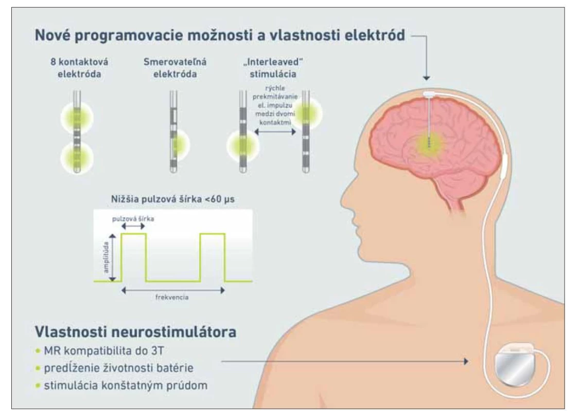 Hardvérové technologické inovácie hlbokej mozgovej stimulácie.<br>
Fig. 2. Hardware technological innovations of deep brain stimulation.