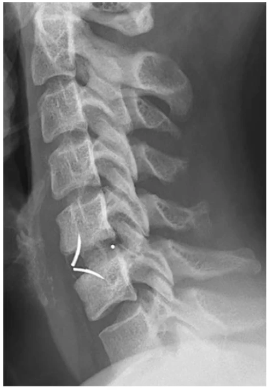 X-ray image after implantation of ROI-C cage in
level C5-6