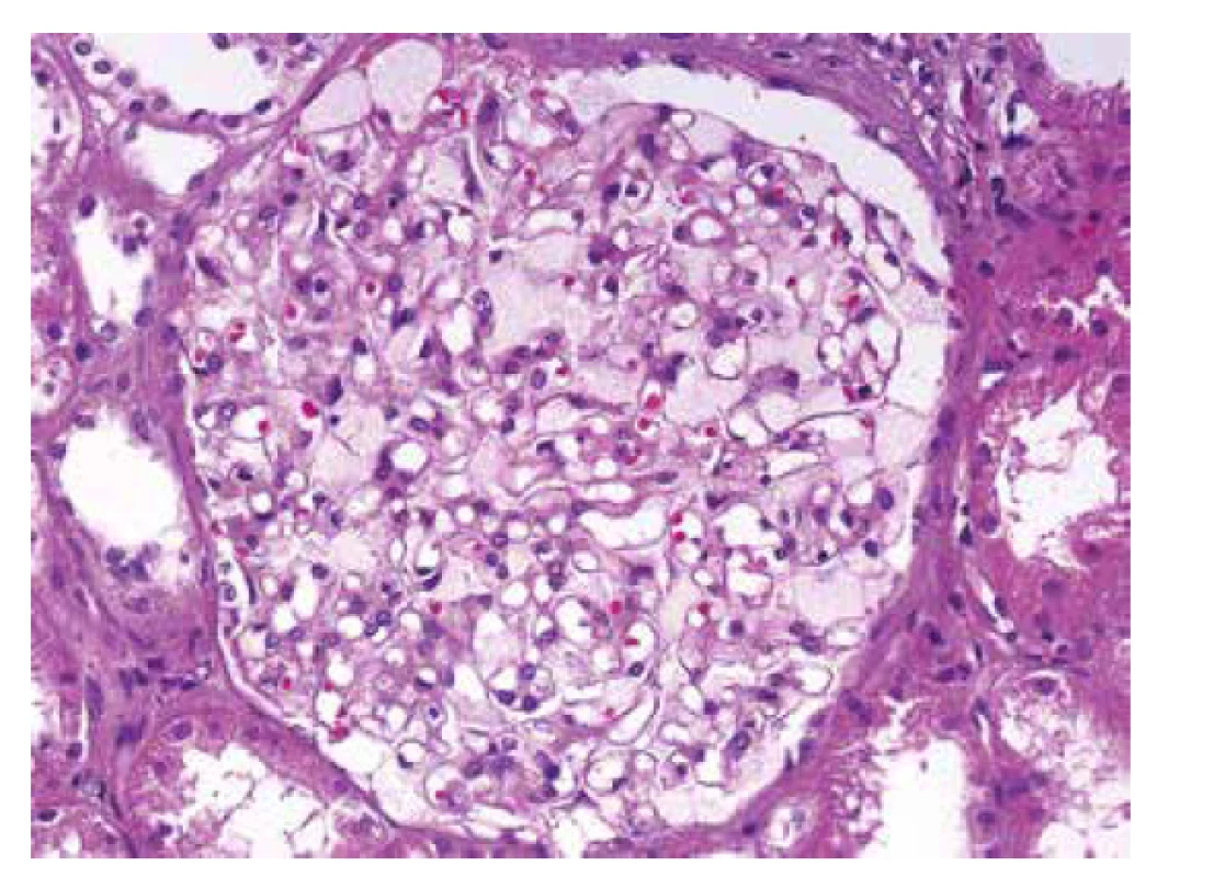 Detail glomerulu s nápadně zvětšenými světlými podocyty. Cytoplasma
podocytů je jemně zrnitá a působí pěnitým dojmem, který způsobují
inkluze lipidů. Zbývající struktury jsou přiměřené (HE, objektiv 40x).