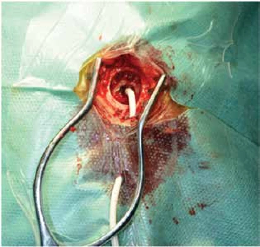 Drenáž subdurálního hematomu z návrtu<br>
Fig. 2: Drainage of subdural hematoma through a burr
hole