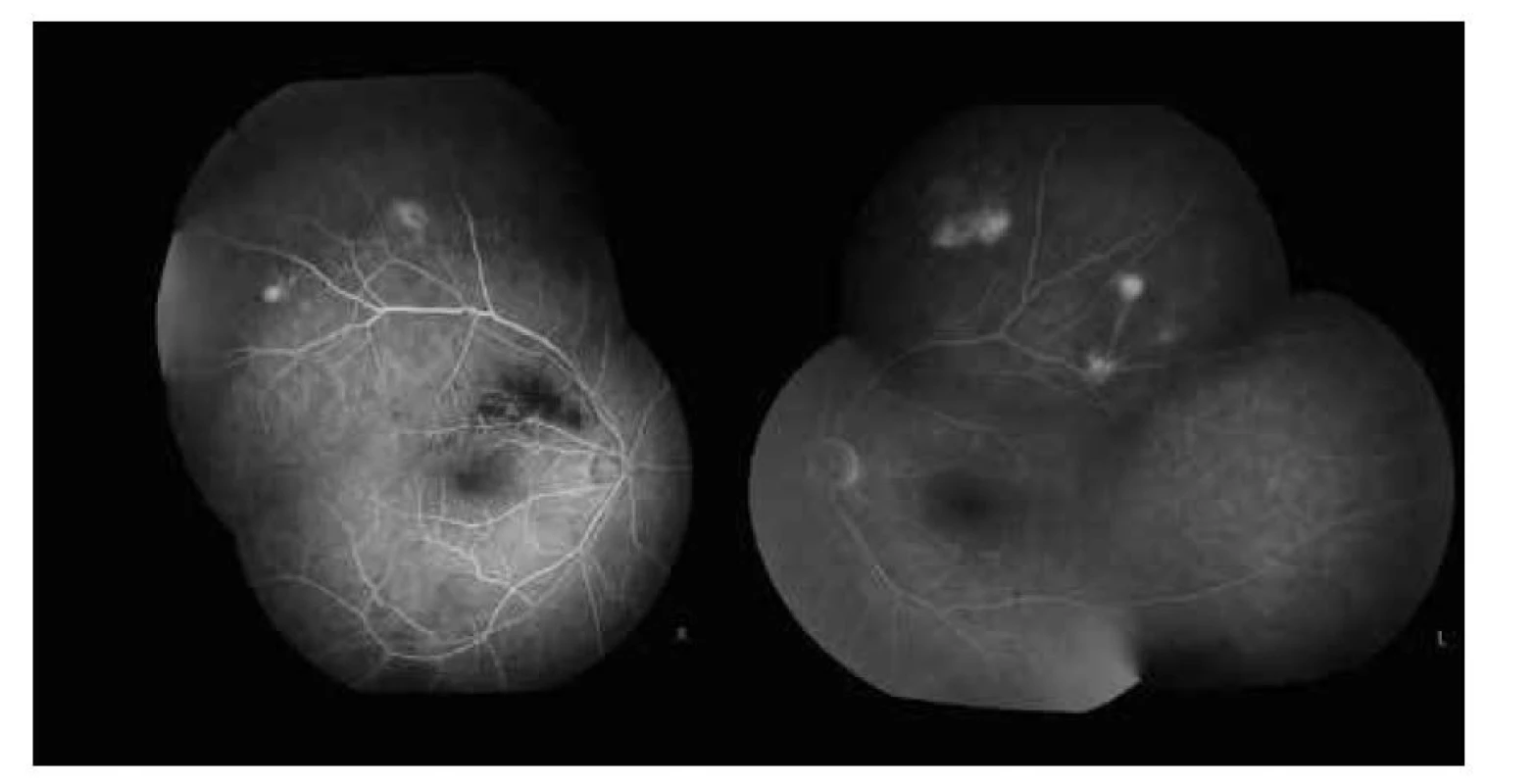 Na fluoresceínovej angiografii je od úvodných fáz prítomná hyperfluorescencia v mieste
kalcifikácii, na pravom oku aj blokáda fluorescencie v mieste intraretinálnej hemorágie pri venóznej oklúzii