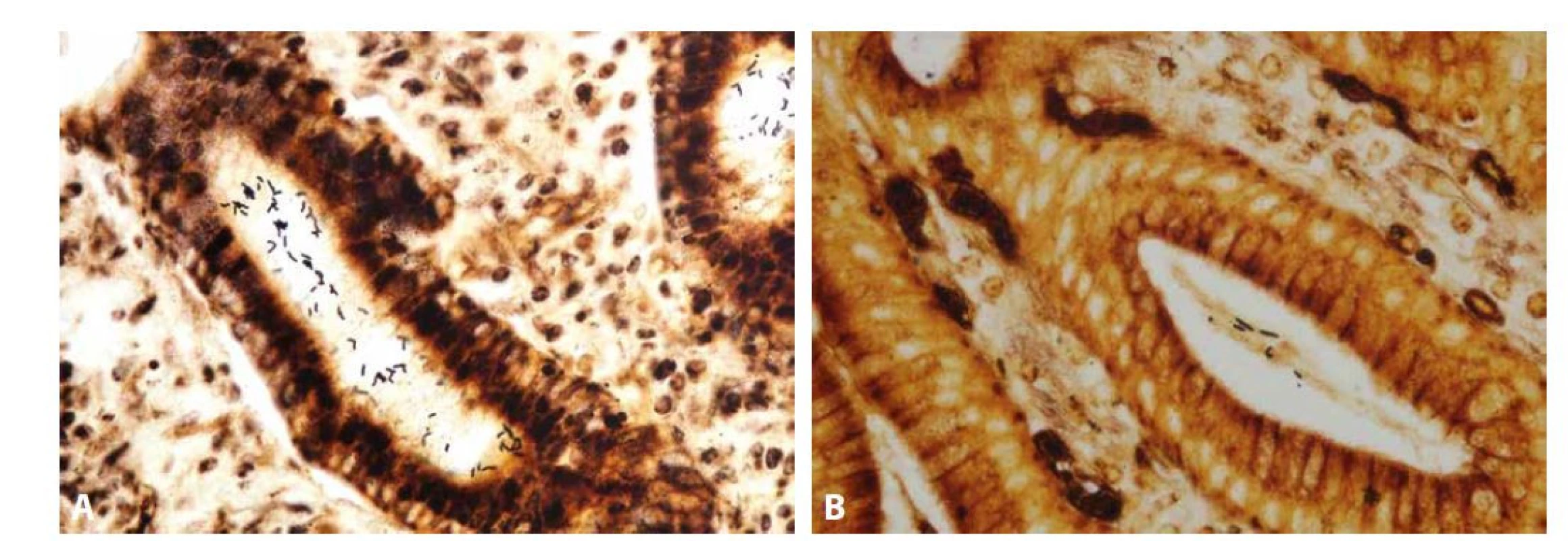 Helicobacter pylori a Helicobacter heilmannii