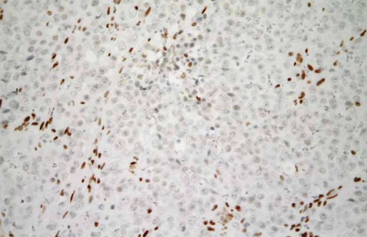 Malobuněčný karcinom hyperkalcemického typu. Nádorové buňky jsou negativní
při průkazu SMARCA4. Hnědé zbarvení jader nenádorových fibroblastů a zánětlivých
buněk lze využít jako pozitivní vnitřní kontrolu (imunohistochemie, původní
zvětšení 400×).