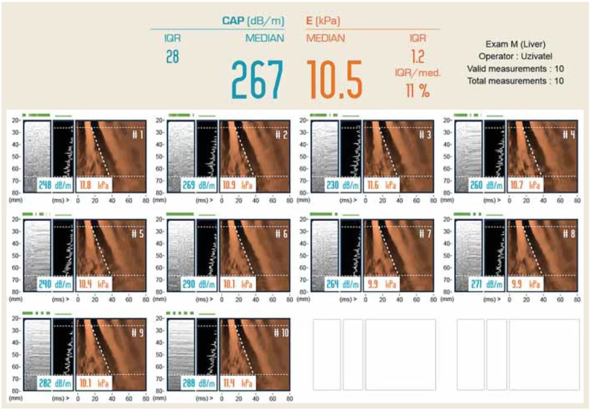 Výsledkový list TE. LS 10,5 Pa odpovídá těžké fibróze jater při HCV infekci.<br>
Fig. 2. TE result sheet. LS 10.5 Pa corresponds to severe liver fibrosis in HCV infection.