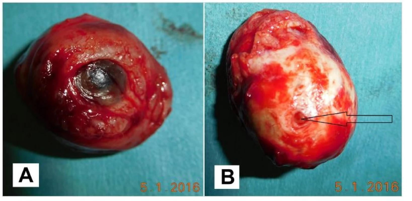 A,B Enucleated eye globe (A), the optic nerve is marked with the arrow (B)