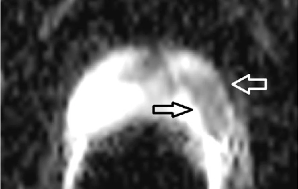 ADC mapa v DWI obraze, transverzální rovina,
šipky vyznačují pole s restrikcí difuze typickou pro nádor<br>
Fig. 2. ADC map in DWI image, transverse plane,
the arrows indicate the fields with diffusion restrictions
typical for the tumor