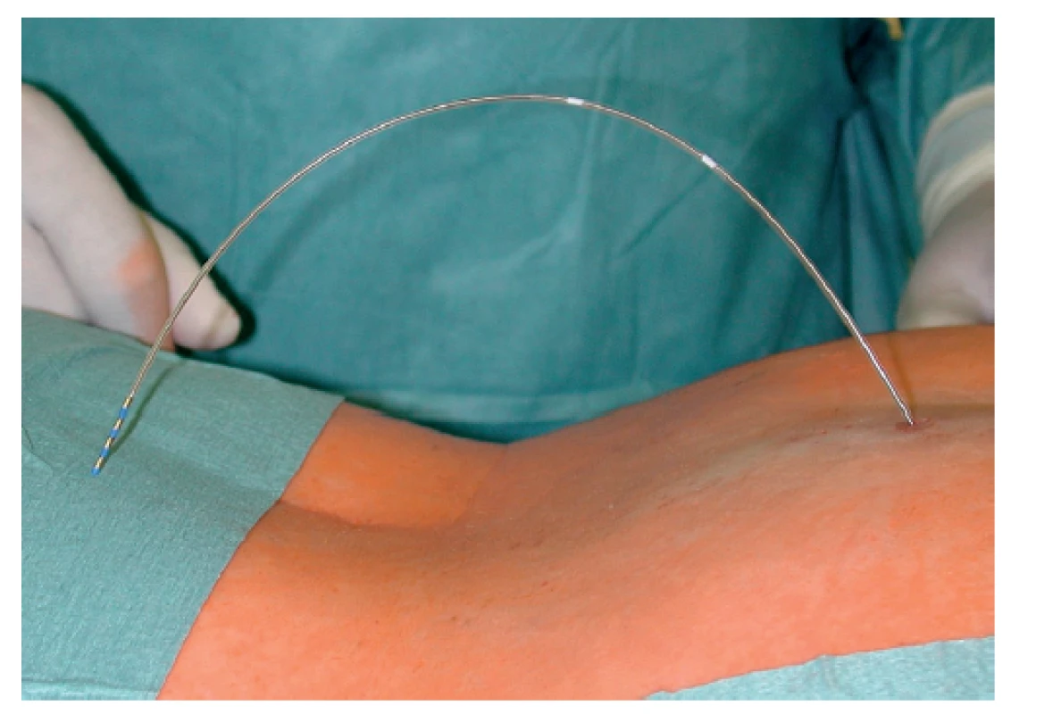 Zavedená „tined lead„ elektroda<br>
Fig. 2: Implanted “tined lead“ electrode