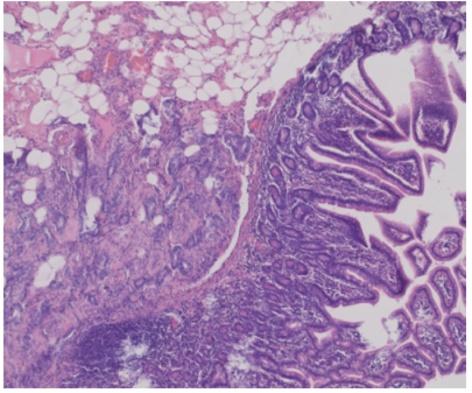 Histological section: invasive adenocarcinoma infiltrating submucosal tissue, spreading under small intestine epithelium, HE staining, 100×