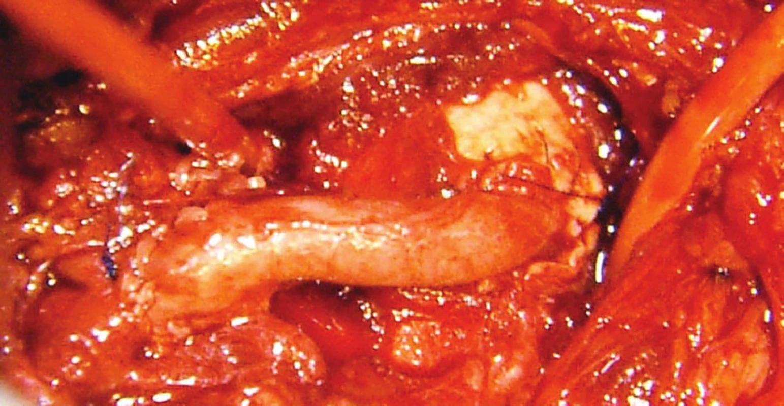 Aorto-trunkálny venózny bypass<br>
Fig. 3: Aorto-celiac venous bypass