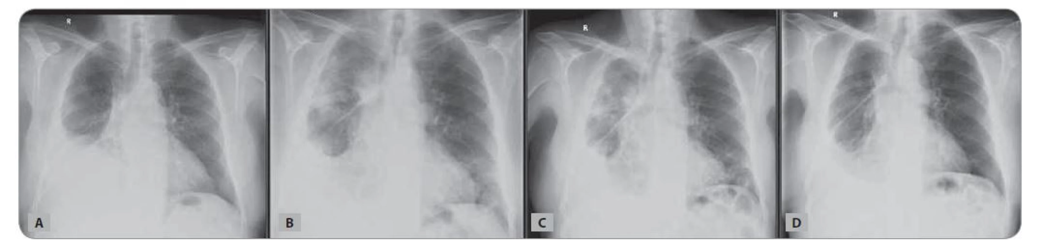 Skiagram hrudníku nemocného z Kazuistiky 1: A) v době zahájení chemoterapie; B) v době pneumonie COVID-19; C) při hodnocení
efektu léčby; D) v odstupu 3 měsíců od koronavirové infekce.