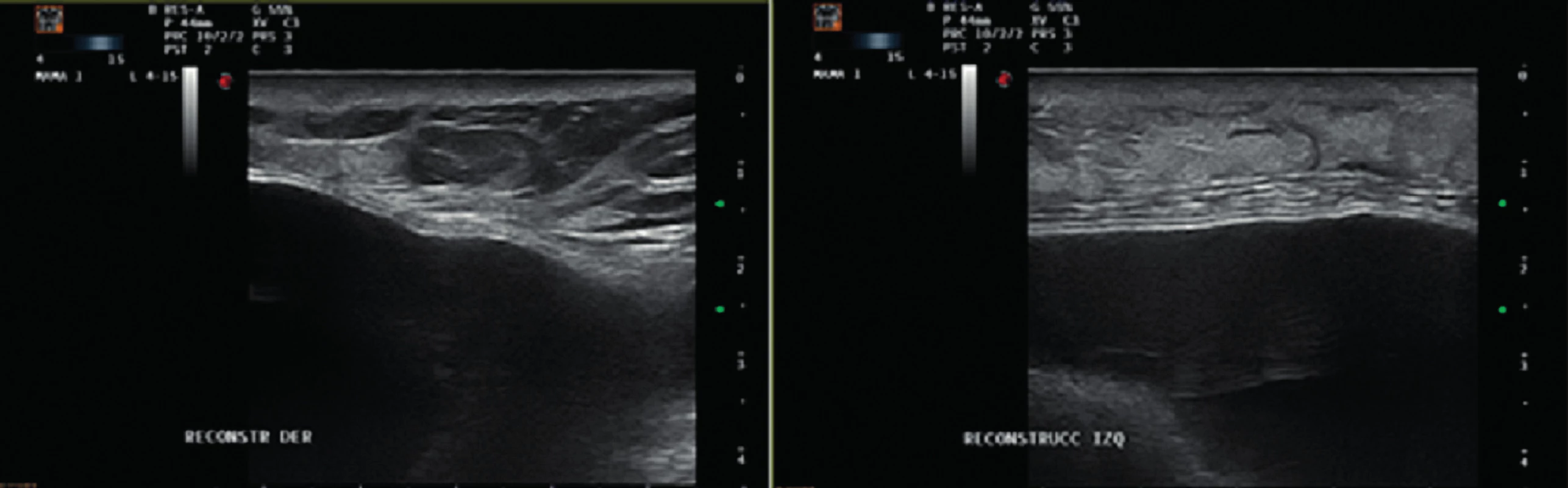 Ultrasound images showing no evidence of seroma or abscess on the right and left sides
Figure
