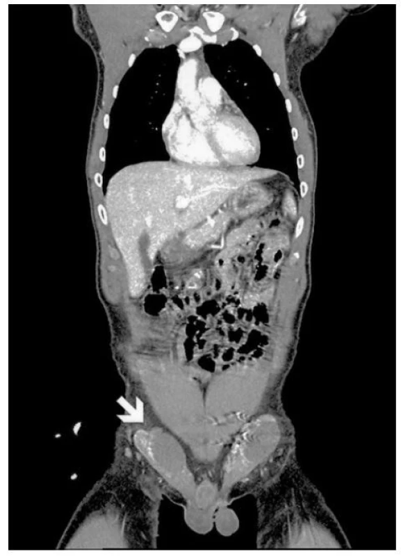 Postkontrastní CT vyšetření – koronální zobrazení
s nálezem dislokovaného varlete (šipka)<br>
Fig. 1. Contrast enhanced CT scan – coronal section
showing the dislocated testis (arrow)